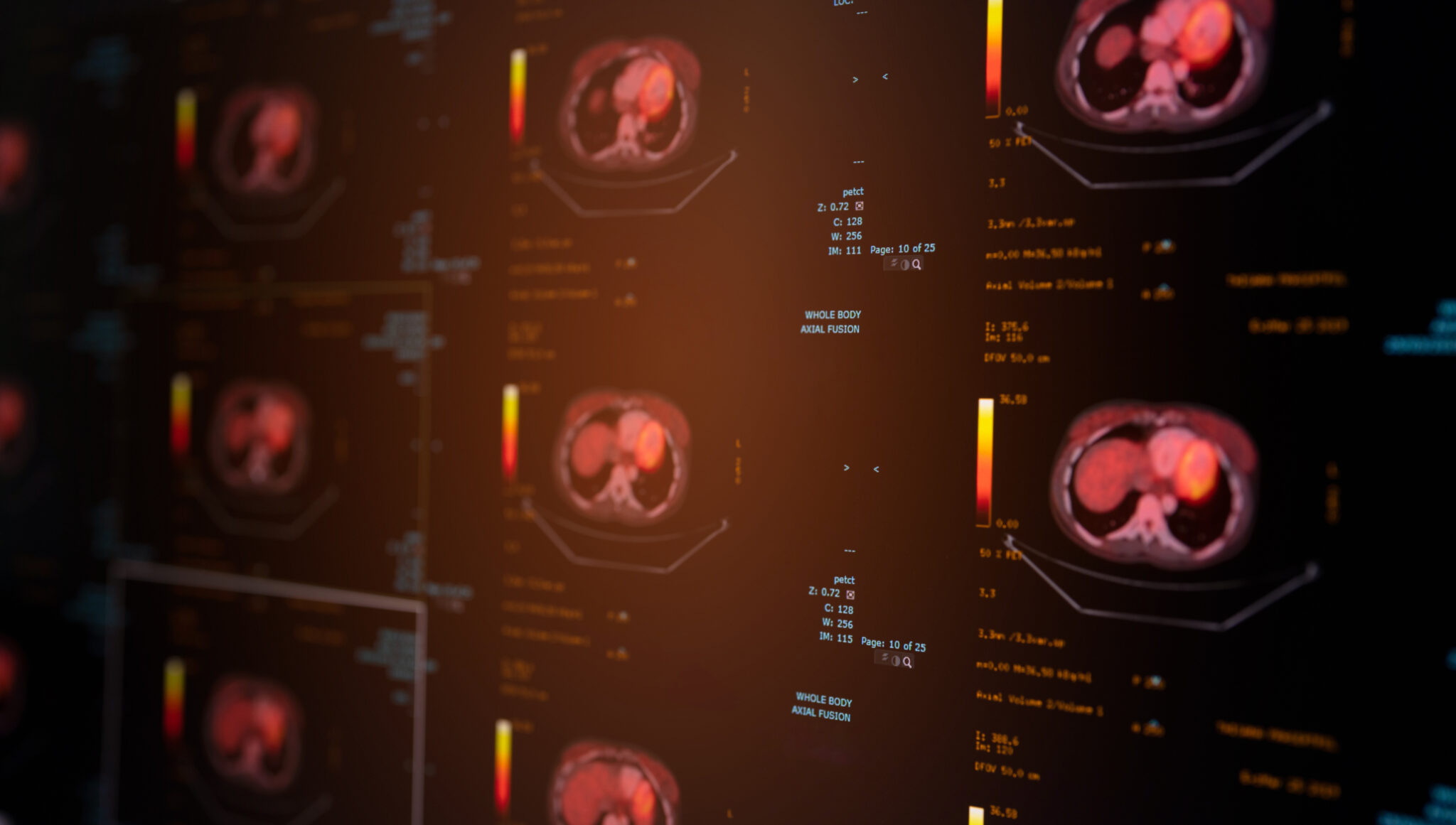 TEP scanners - CIMOF - Services de Médecine Nucléaire de Toulouse